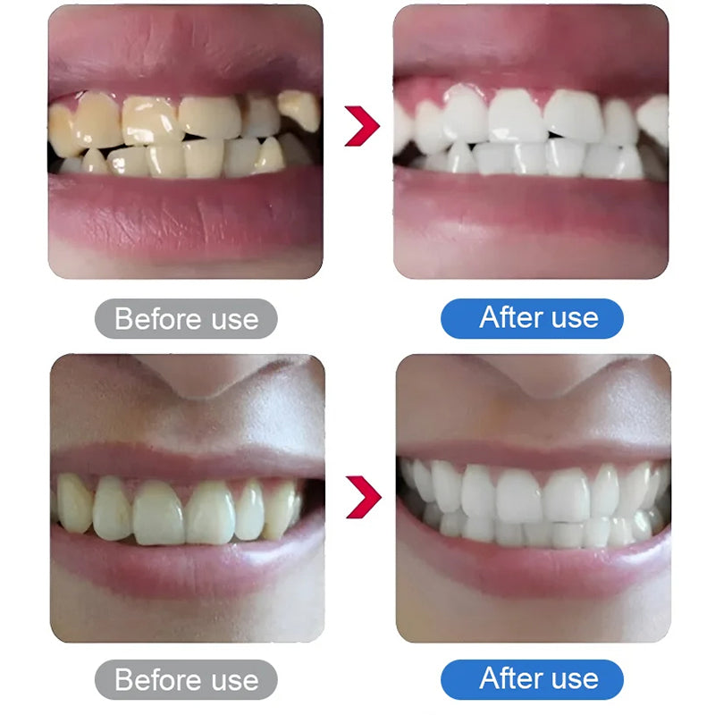Electric Ultrasonic Dental Scaler for Tartar and Plaque Removal